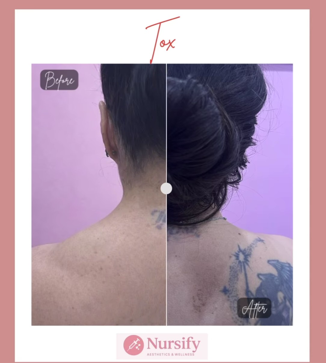Barbie Tox Botox result at Nursify Albuquerque
