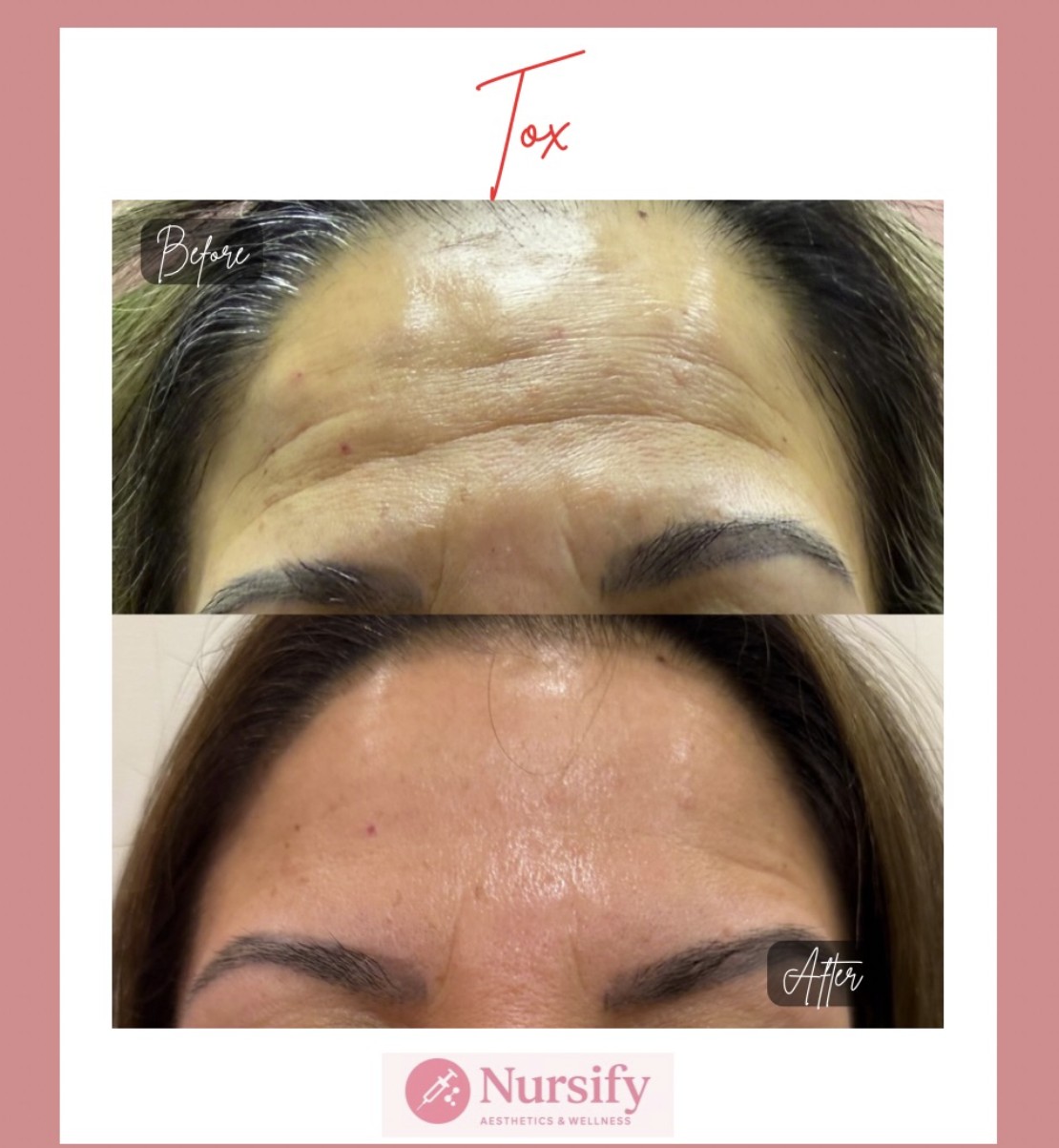 Natural Botox result Albuquerque NM