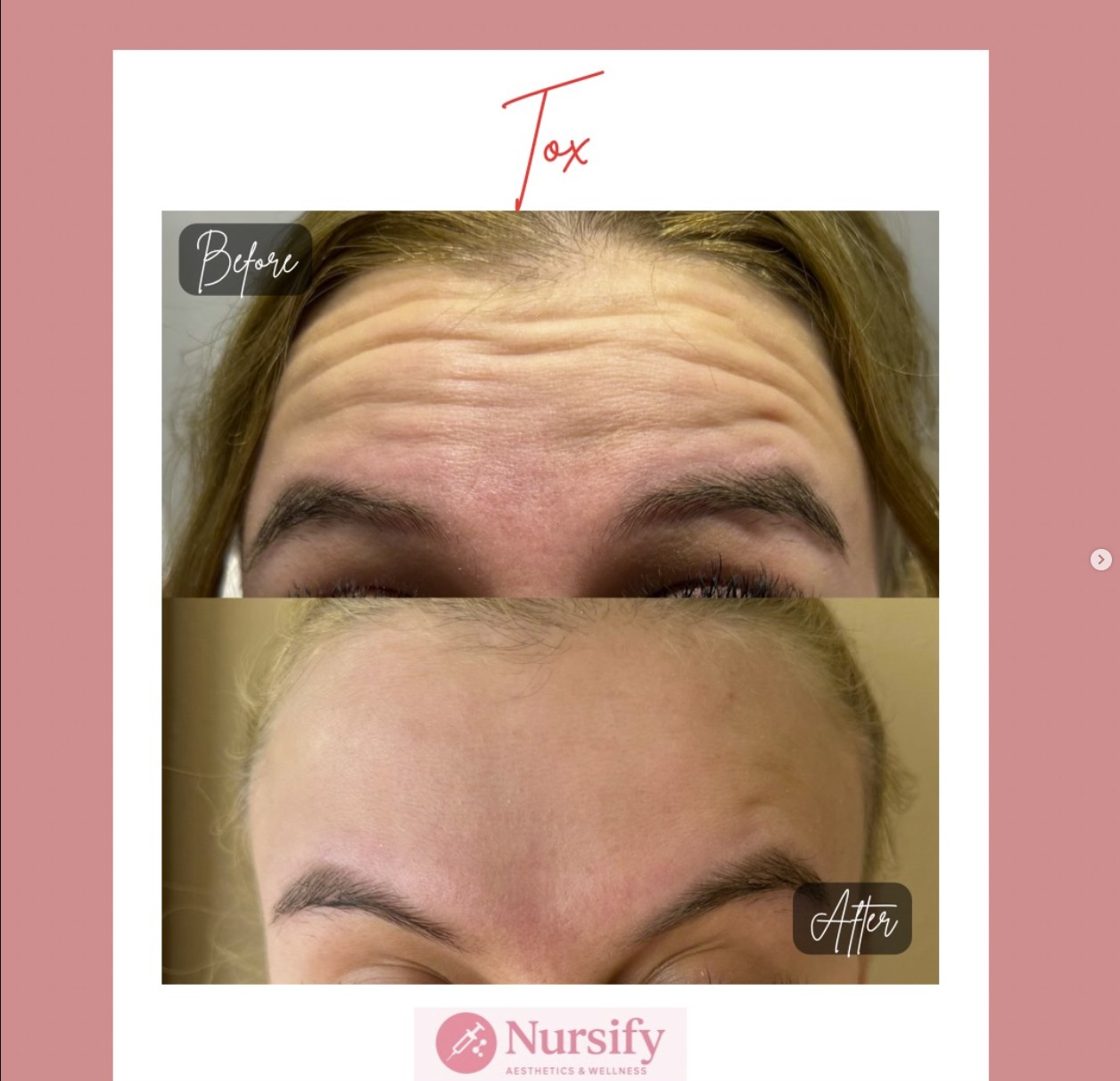 Botox forehead lines result Nursify