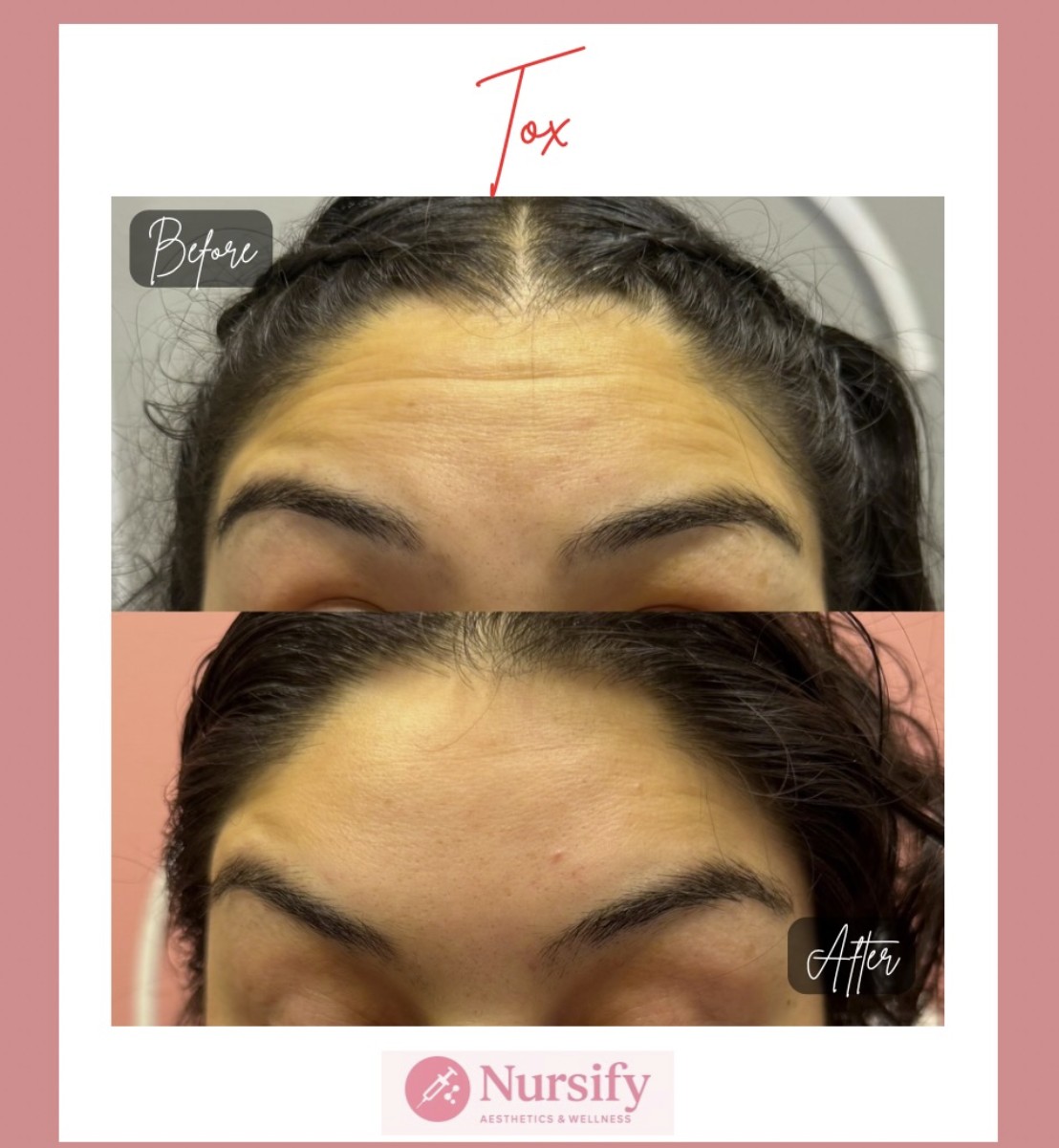 Wrinkle relaxer results Albuquerque