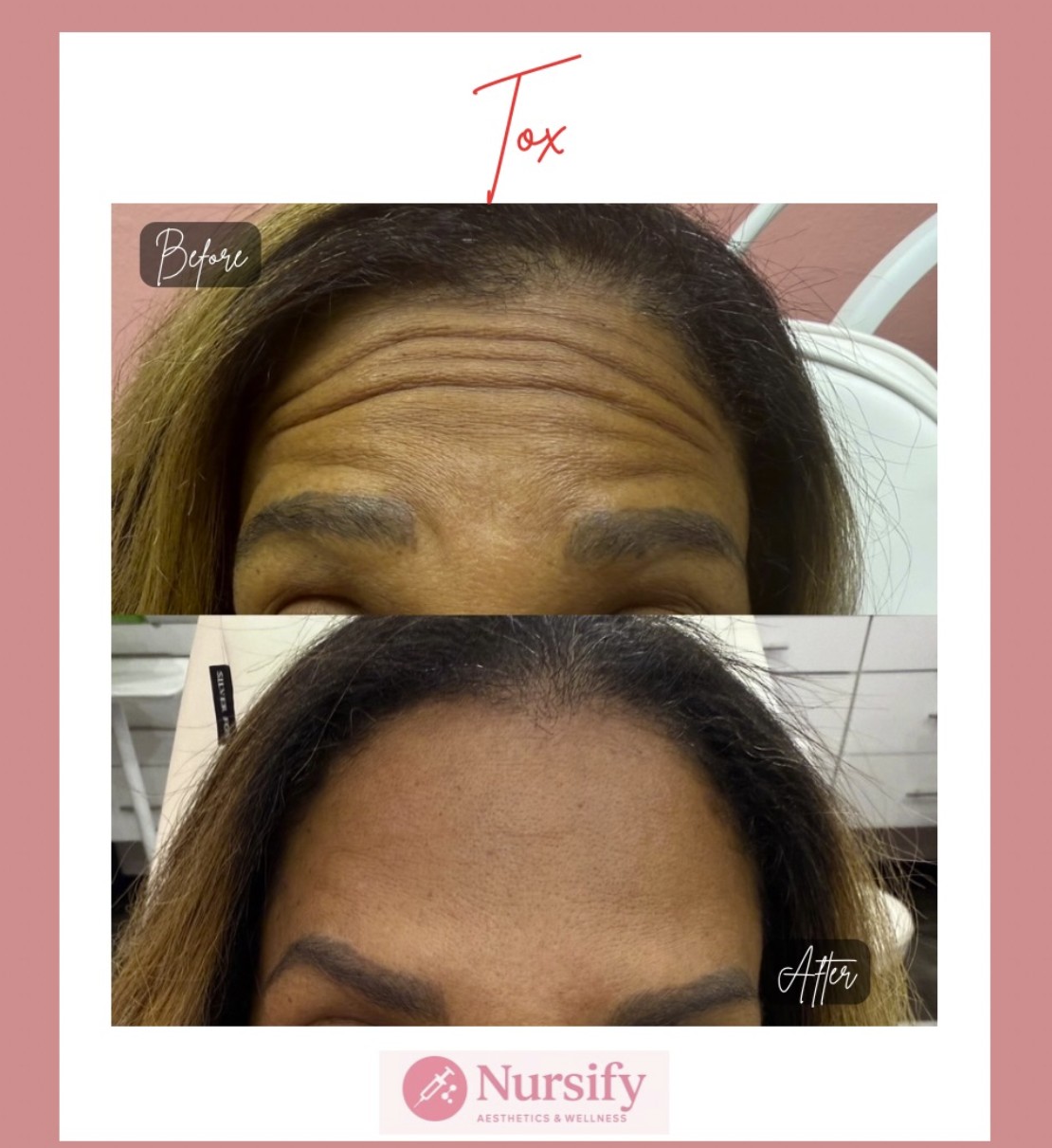 Crow's feet Botox result at Nursify