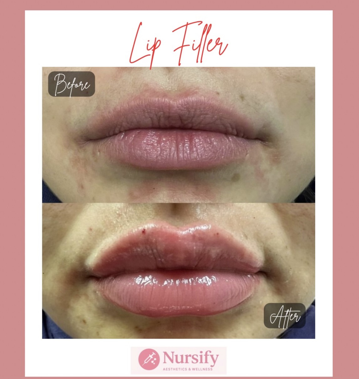 Facial filler before and after Nursify