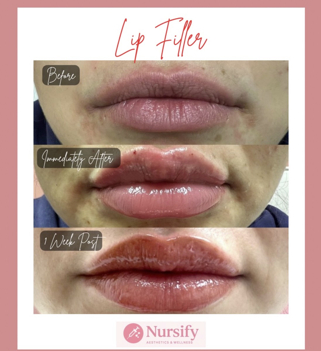 Cheek filler enhancement Albuquerque