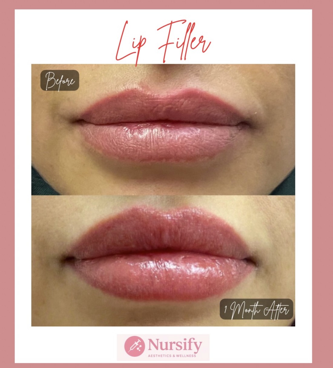 Filler treatment result at Nursify