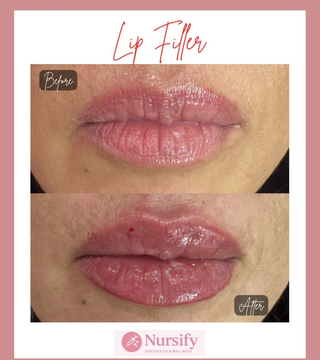 Dermal filler result Albuquerque