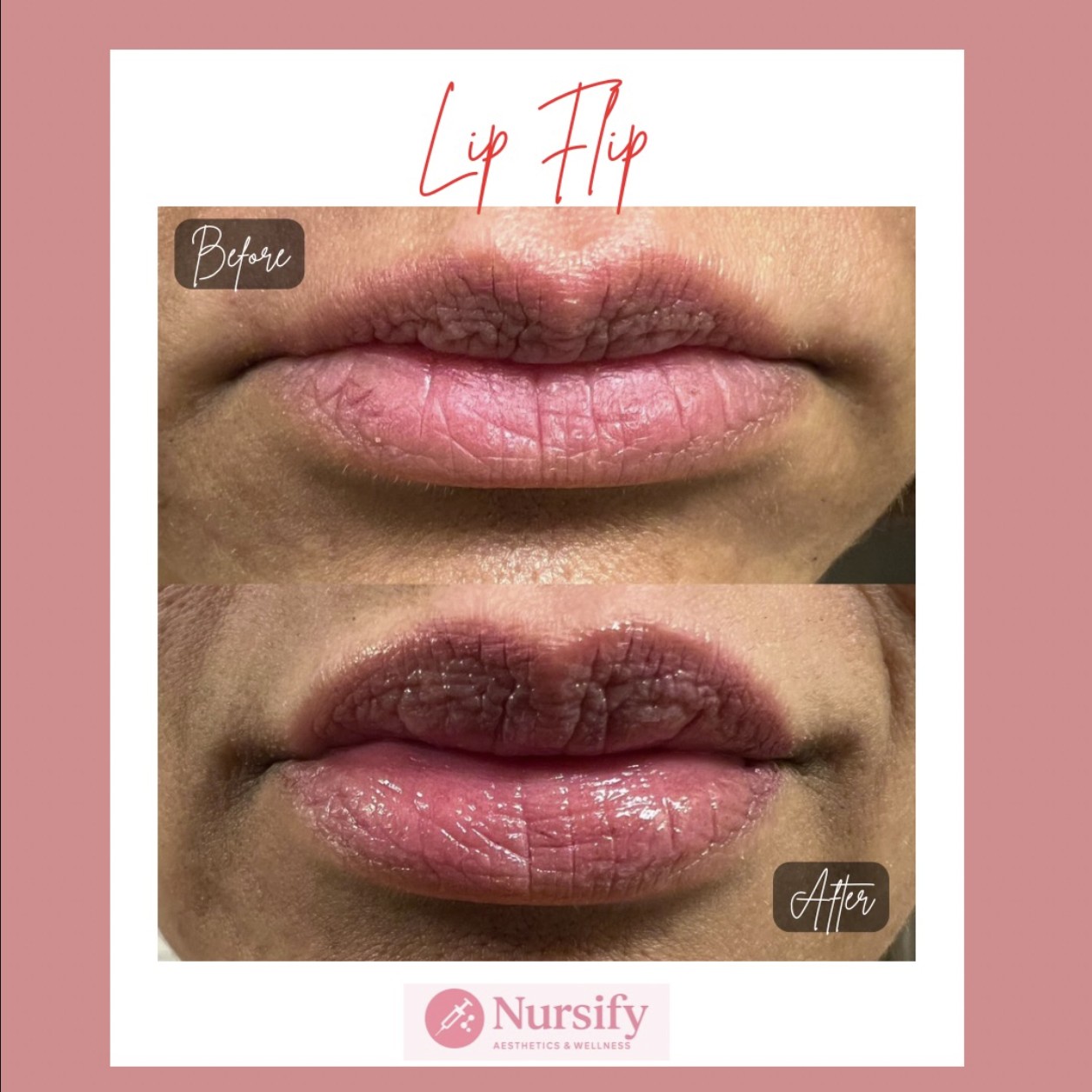 Lip flip result with Botox at Nursify