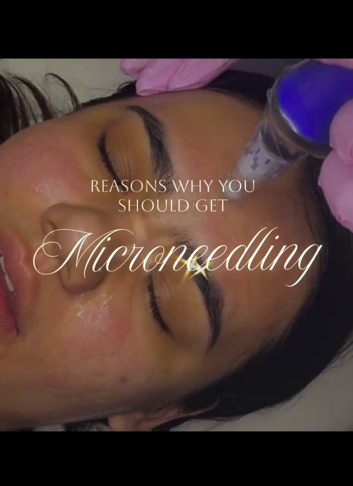 SkinPen microneedling result Albuquerque